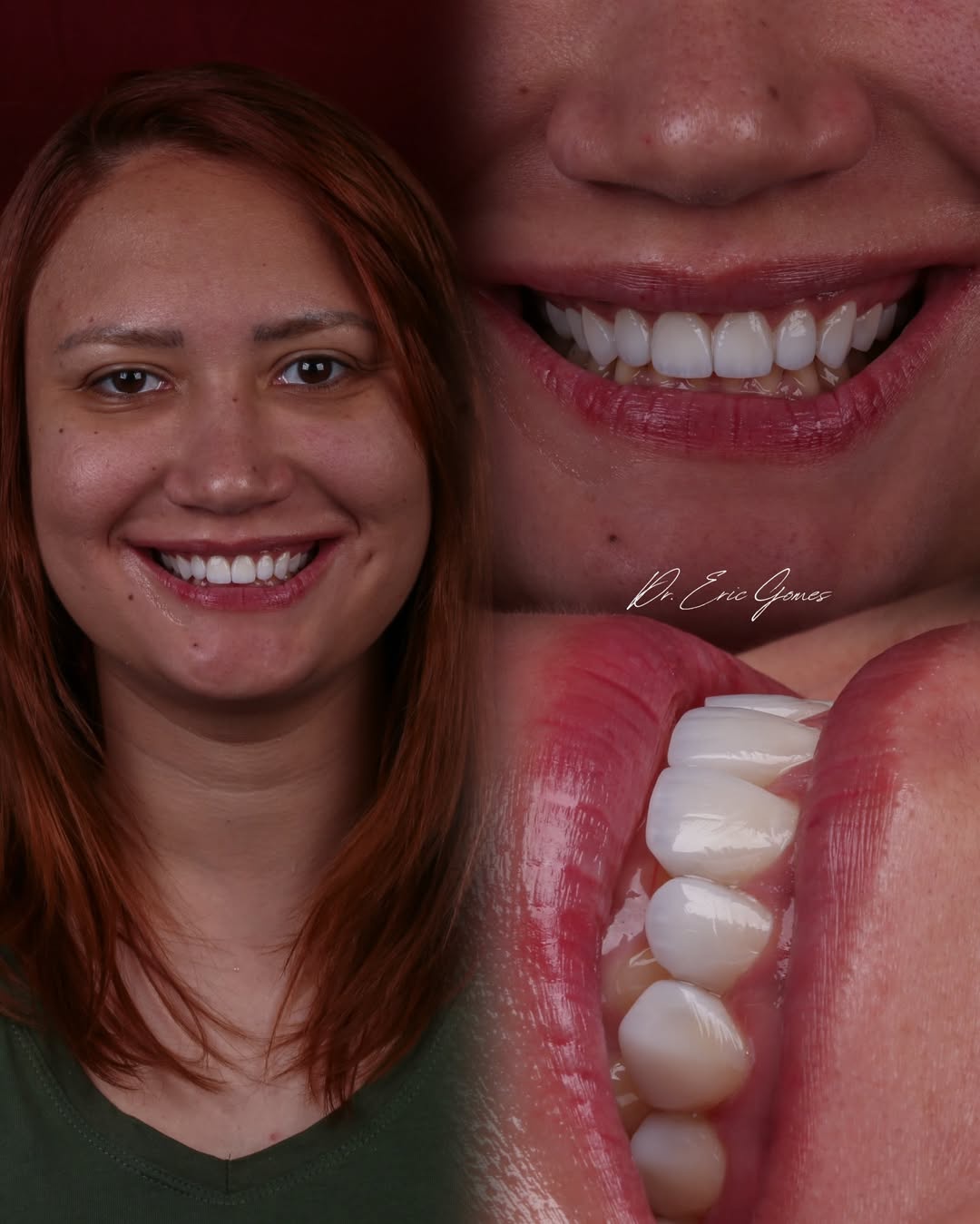 Sorriso visto de frente e detalhes dos dentes